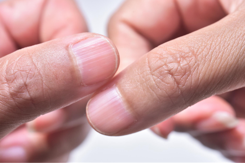 Móng tay sần sùi có thể là dấu hiệu cho thấy cơ thể đang mắc một số bệnh về nhiễm khuẩn