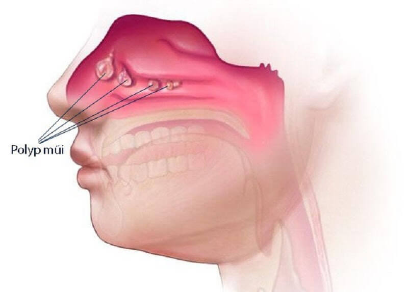 Polyp mũi 