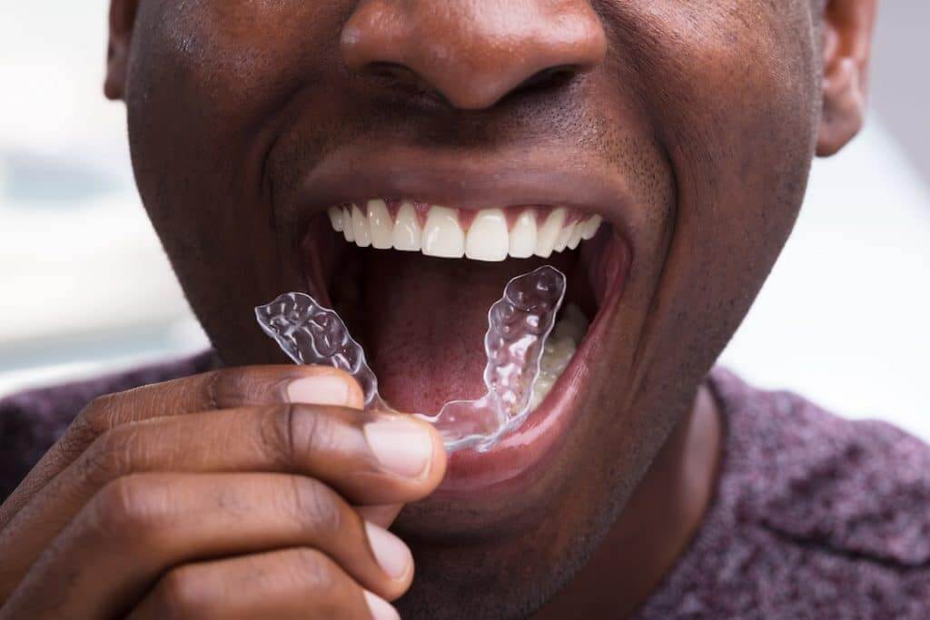 Niềng răng hỗ trợ điều trị chứng nghiến răng