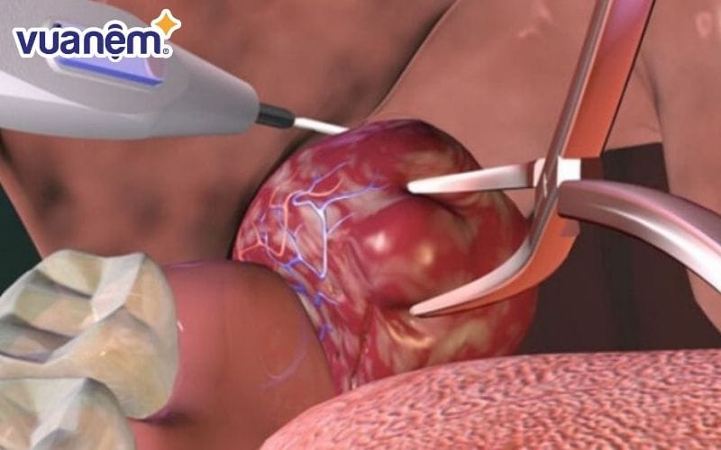 Bạn có thể tìm hiểu phương pháp cắt amidan