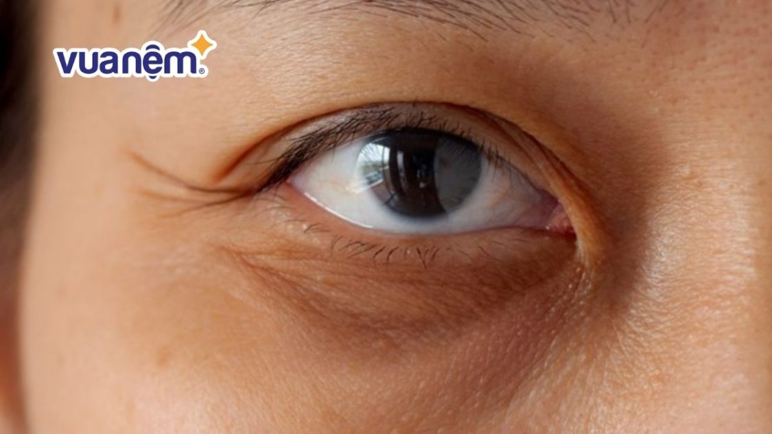 Thiếu ngủ có gây quầng thâm mắt?