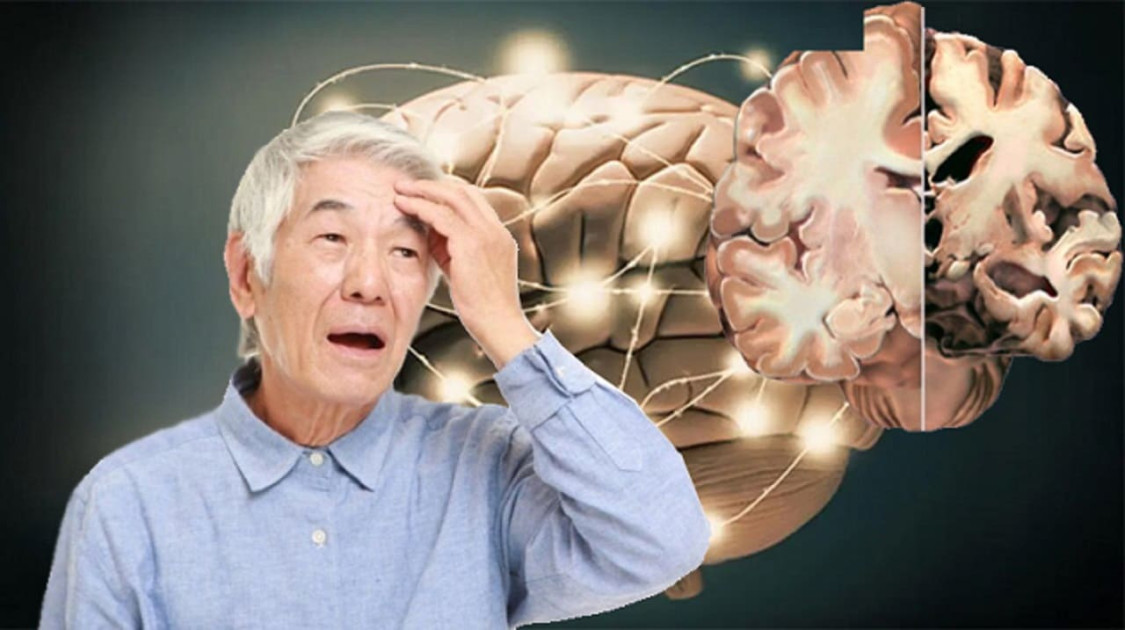 Mối liên hệ giữa bệnh Alzheimer và giấc ngủ
