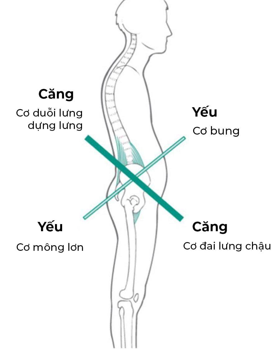 bị võng lưng