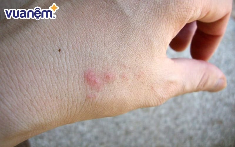Nhận diện qua vết cắn