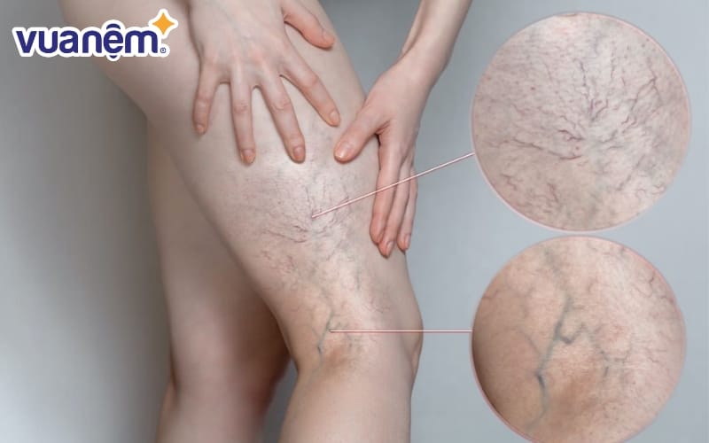 Dấu hiệu của suy giãn tĩnh mạch là những đường tĩnh mạch hiện rõ