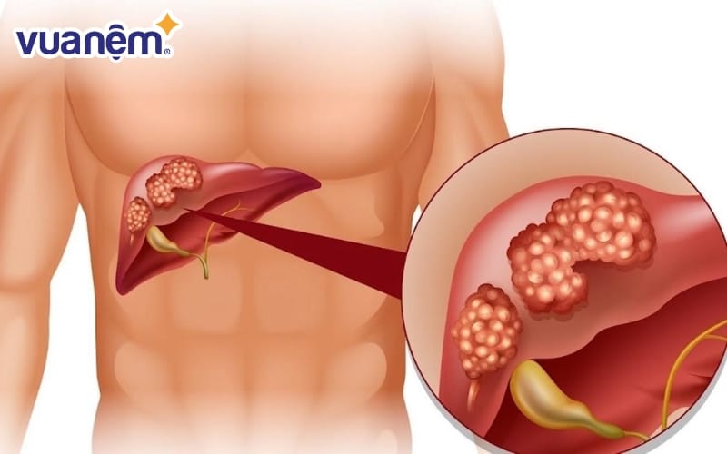 Nước muối loãng có đặc tính kháng khuẩn nhẹ, giúp hỗ trợ làm sạch đường tiêu hóa 