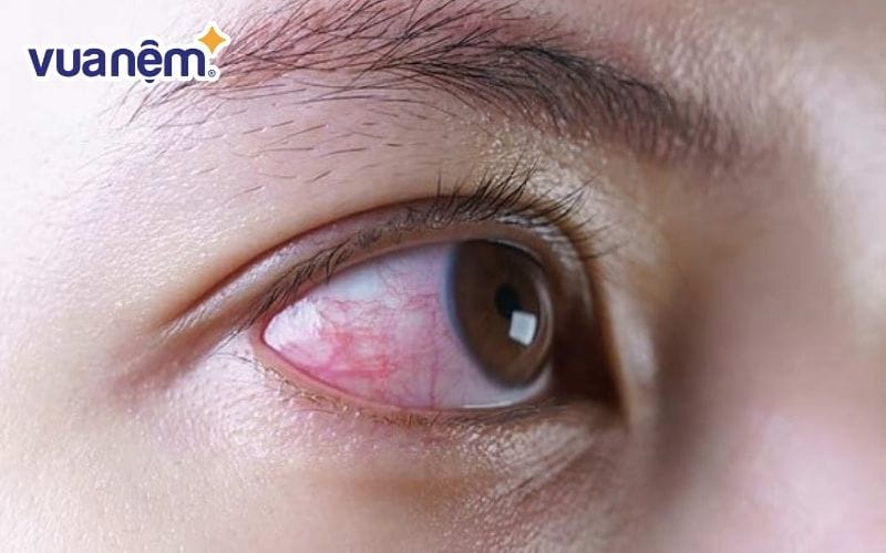 Đeo lens đi ngủ gây nhiều ảnh hưởng cho mắt