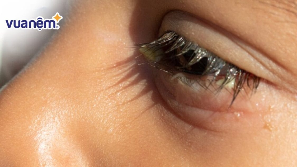 Mắt bé bị đổ ghèn khi ngủ dậy: 3 Lưu ý và cách khắc phục