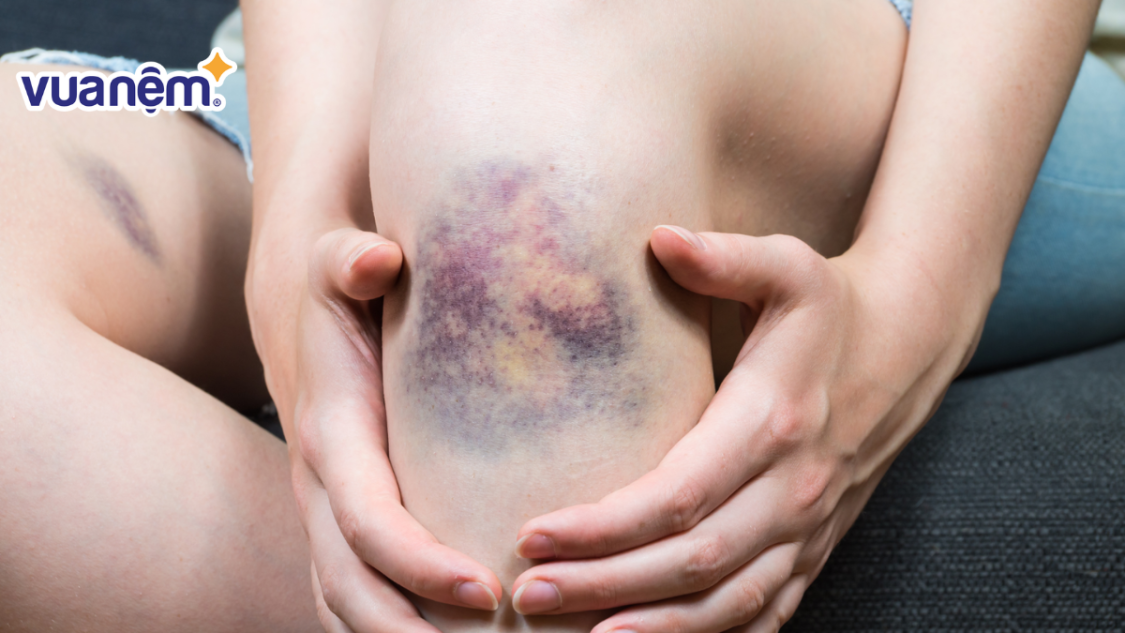 Ngủ dậy bị bầm tím ở chân: Nguyên nhân, cách khắc phục