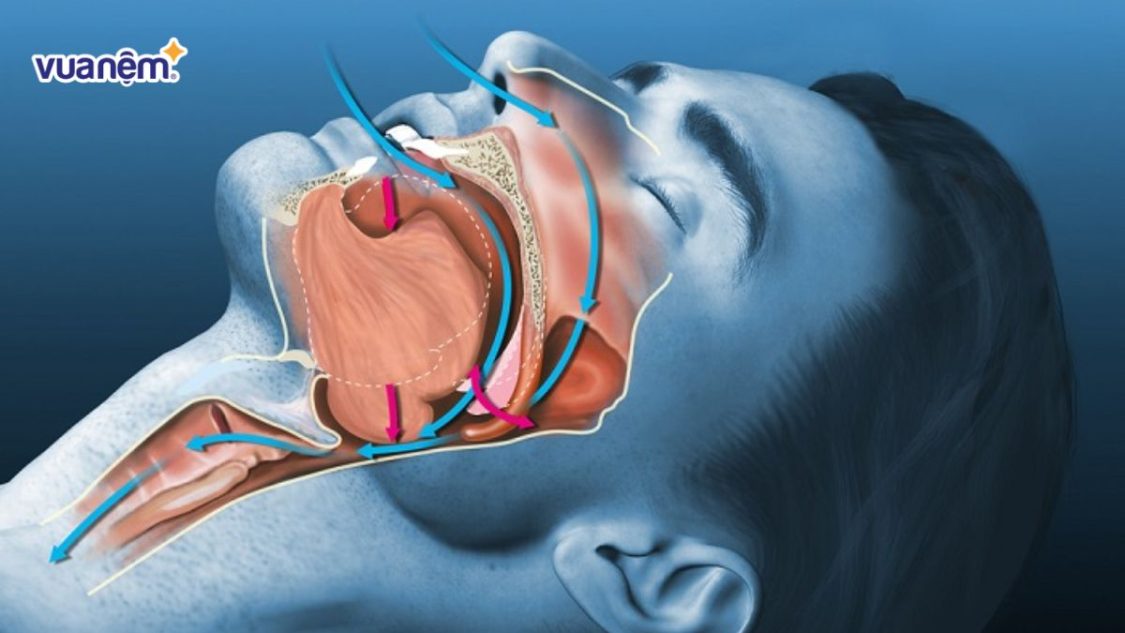 65% người Việt có triệu chứng ngưng thở khi ngủ, bạn có nằm trong số đó?