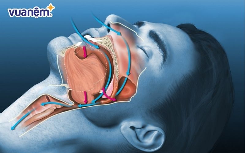 Ngưng thở khi ngủ là gì