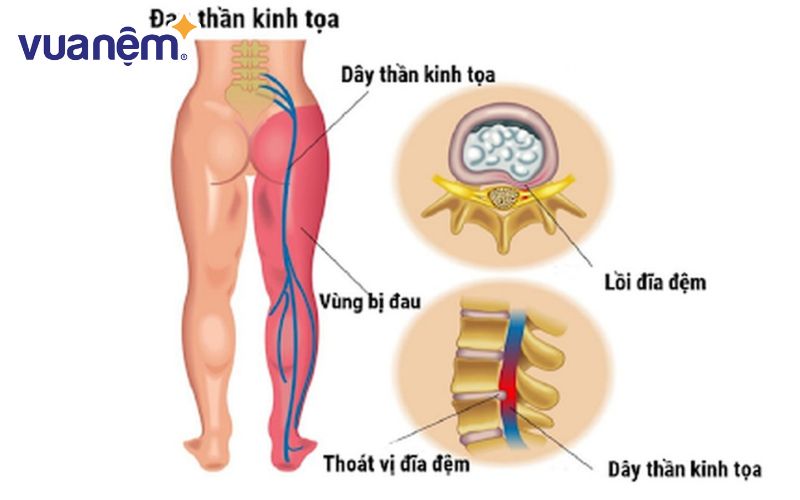 Dây thần kinh tọa kéo dài từ phần dưới thắt lưng đến tận các ngón chân