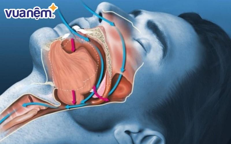 Tìm hiểu nguyên nhân gây ngáy khi ngủ