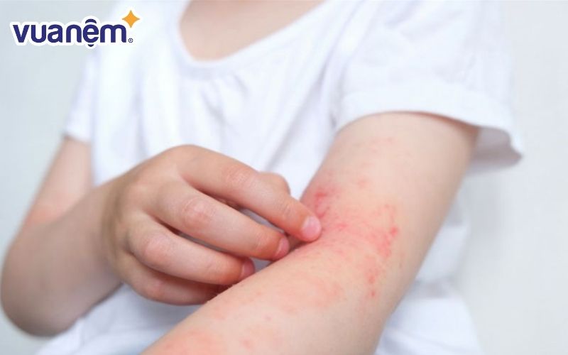 Mạt bụi có ảnh hưởng đối với những ai có làn da nhạy cảm