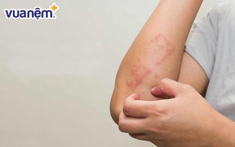 Nệm ẩm trong mùa nồm gây ra các bệnh về da liễu