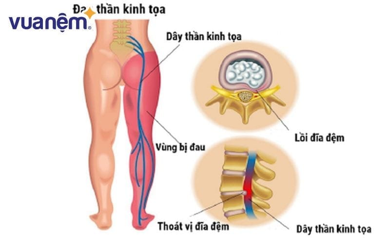 Dây thần kinh tọa kéo dài từ phần dưới thắt lưng đến tận các ngón chân